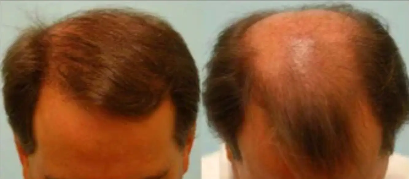 تجربتي زراعة الشعر في السعودية