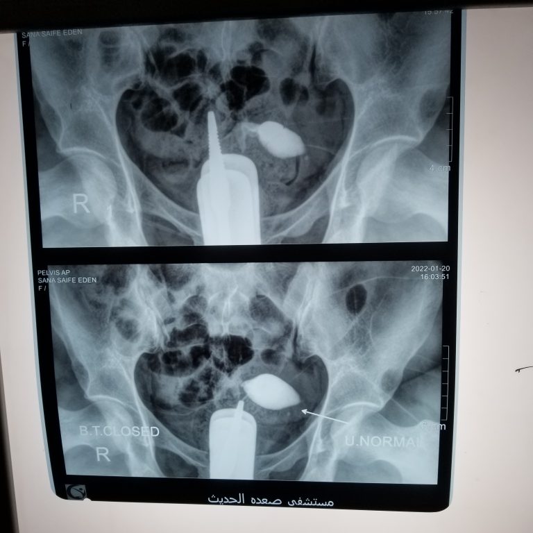 عادي اسوي اشعه الصبغة وقت الدورة؟