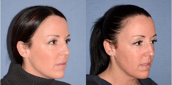 كم عدد جلسات الهايفو ؟