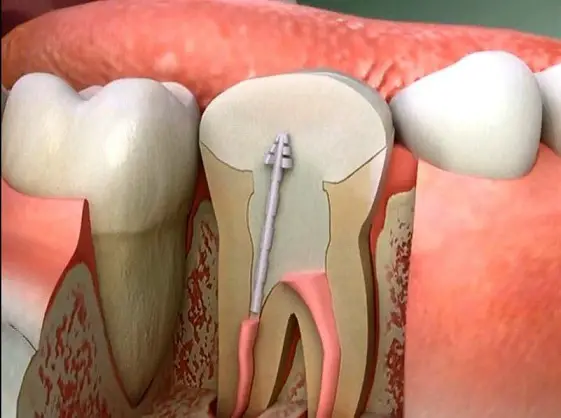 كيفية تمويت عصب الضرس في المنزل عالم حواء