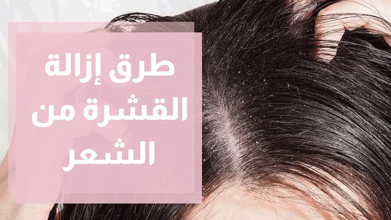 ما هي أهم طريقة ازالة القشرة من الشعر؟