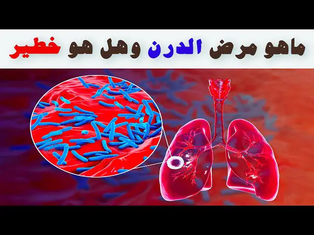 ما هو مرض الدرن؟ وهل هو خطير؟