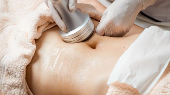 تجربتي مع جلسات التخسيس الموضعي